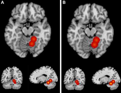 Frontiers | A Meta-Analysis Of Gray Matter Differences Between ...